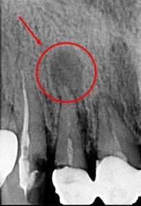 Granuloma a foggyökér