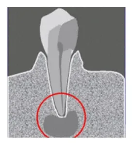 Granuloma a foggyökér