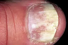 unghiile de la picioare Fungus (onicomicoza), simptome, stadii, diagnostic