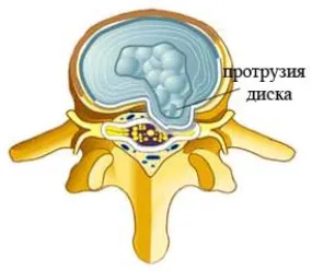 hernia de disc (disc alunecat) hernia de disc