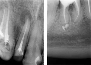 Granulomul pe radacina dintelui