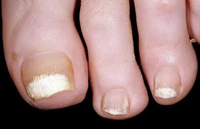 unghiile de la picioare Fungus (onicomicoza), simptome, stadii, diagnostic