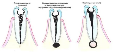 Гранулом на зъб корен