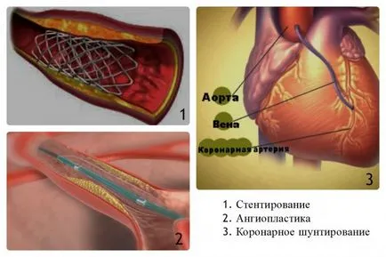 Коронарната болест на сърцето диагноза и лечение, стентиране и байпас, видео