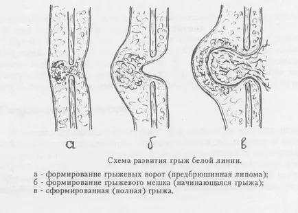 Коремните видове хернии, симптоми, причини и лечение