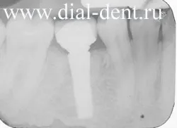 A fogászati ​​implantátumok részletes képek