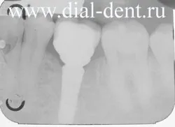 Implanturile dentare cu fotografii detaliate