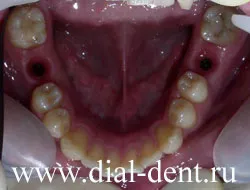 Implanturile dentare cu fotografii detaliate