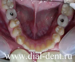 Implanturile dentare cu fotografii detaliate