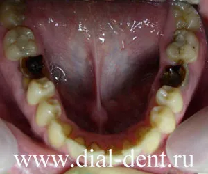 Implanturile dentare cu fotografii detaliate