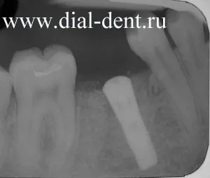 A fogászati ​​implantátumok részletes képek