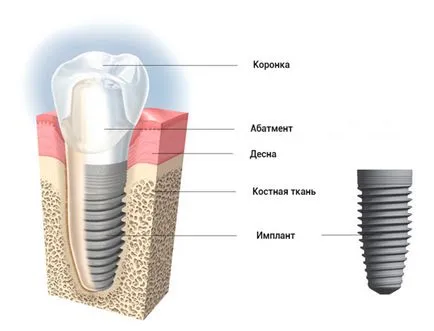 Зъбните импланти - операция снимка и неговите резултати