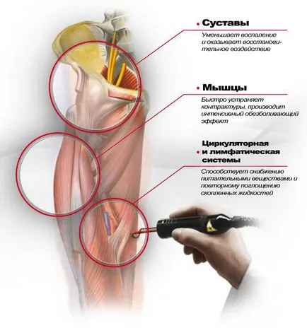 cu laser intens