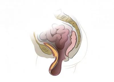 Cum de a trata prolapsul uterin la vârstnici, și ce să facă