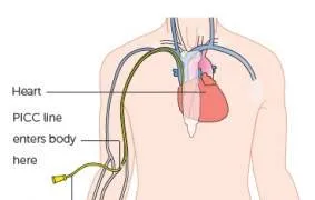 Как е химиотерапия - видове, пътища на експозиция, thebestmedic