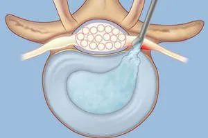 Cum este operațiunea de microchirurgie pentru hernie