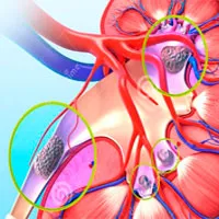 O piatră în simptomele pelvis renal și de tratament, ce să facă