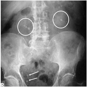 O piatră renal pelvis 10 importante cauze, simptome, tratament