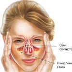 Hurutos sinusitis tünetek és a kezelés