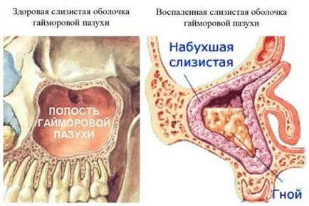 Hurutos sinusitis kezelésére és tünetei ödéma-hurutos formában, nasmorku-net