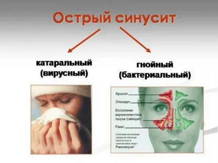 Hurutos sinusitis kezelésére és tünetei ödéma-hurutos formában, nasmorku-net