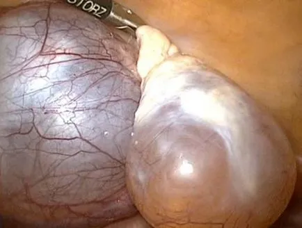 Кисти на яйчниците - снимка патология, резултатите ултразвук, експлоатация снимка