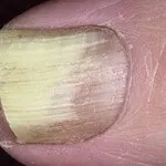 Clasificarea și simptome de ciuperca unghiilor cu privire la gradul de deteriorare