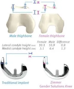 Térd belső protézis Zimmer - a helyreállítás a motoros aktivitás