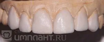 Cazul clinic de restaurare estetică în dentiția anterioară