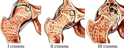 Coxarthrosis 3 fok, a tünetek és kezelések