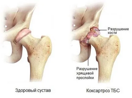 Coxarthrosis 3 fok, a tünetek és kezelések