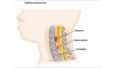 Összenyomó myelopátia nyaki gerinc okok, tünetek, kezelés