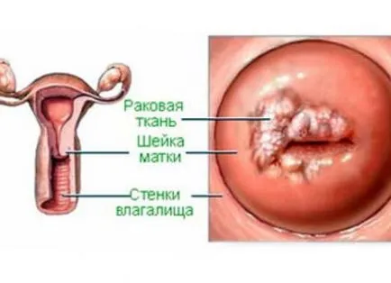 negii de col uterin