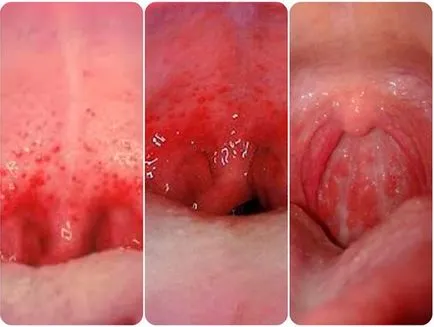 Червена гърлото на детето, отколкото да се лекува, как да разпознават възпалено гърло и изглежда (снимки)