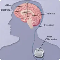 A szklerózis multiplex kezelésére módszer a mély agyi stimuláció - orvosi portál EUROLAB