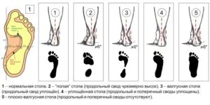 Лечение на костите възпаление на палеца на крака облекчава симптомите