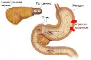 Tratamentul adenomului a pancreasului