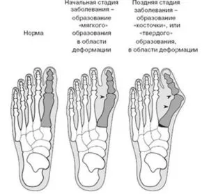 Лечение на костите възпаление на палеца на крака облекчава симптомите