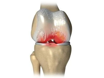 Kezelése deformáló arthrosis a térd népi jogorvoslat