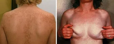 Pityriasis (цветно) лишаване