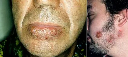 Pityriasis (colorate) lipsirea