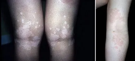 Pityriasis (цветно) лишаване