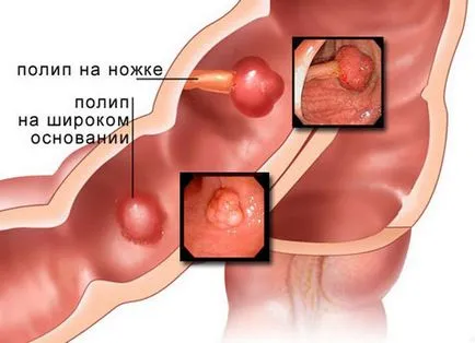 Tratamentul de polipi la stomac, fără medicație și operații