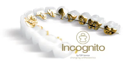 Incognito lingual nadrágtartó, a költségek telepítése fogszabályozó inkognitóban