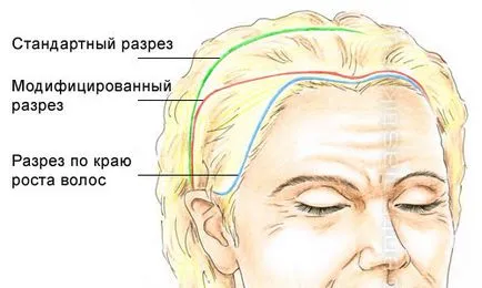 Лифтинг (стягане) на челото и веждите преглед ефективните начини за