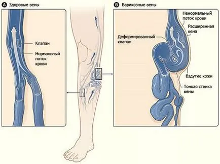 Lemon in tratamentul venelor varicoase, manualul medicale Poporului