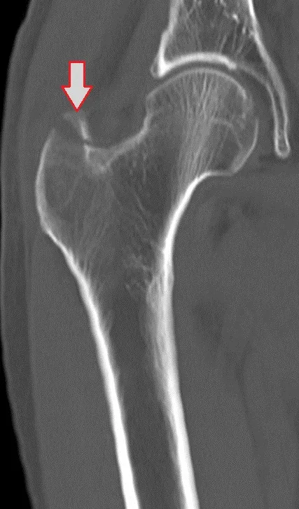 Diagnosticul radiologic al fracturilor de femur, un al doilea aviz