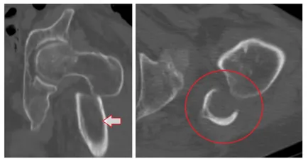 Diagnosticul radiologic al fracturilor de femur, un al doilea aviz