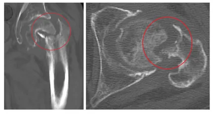 Diagnosticul radiologic al fracturilor de femur, un al doilea aviz