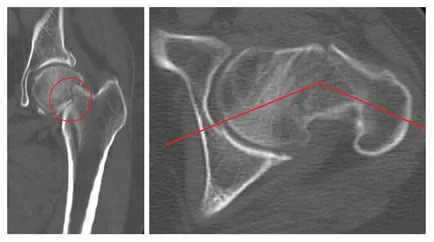 Diagnosticul radiologic al fracturilor de femur, un al doilea aviz